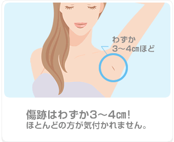 傷跡はわずか3~4㎝!ほとんどの方が気付かれません。